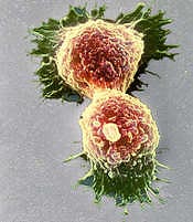 alcohol causes breast cancer