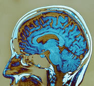 brain damage from alcohol